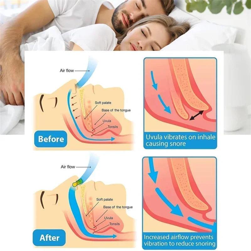 Sleep Easy: Anti-Snoring Corrector - StarsKing Technology